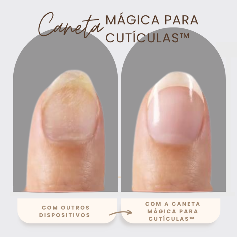 Caneta Mágica para Cutículas™ | Remova Cutículas Sem Dor, com Resultado Profissional em Casa